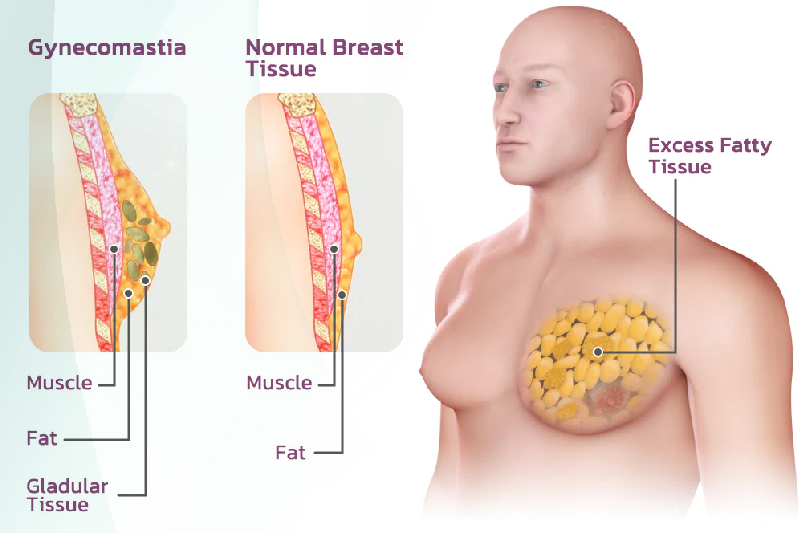 Gynecomastia